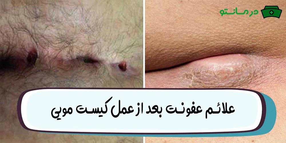 علائم عفونت بعد از عمل کیست مویی (عود کیست مویی بعد از عمل)