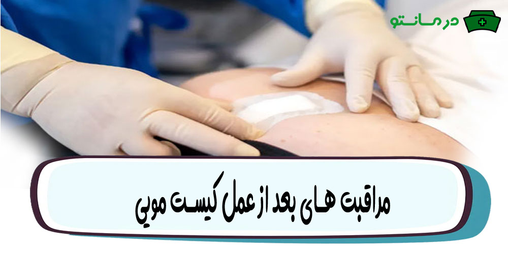مراقبت های بعد از عمل کیست مویی