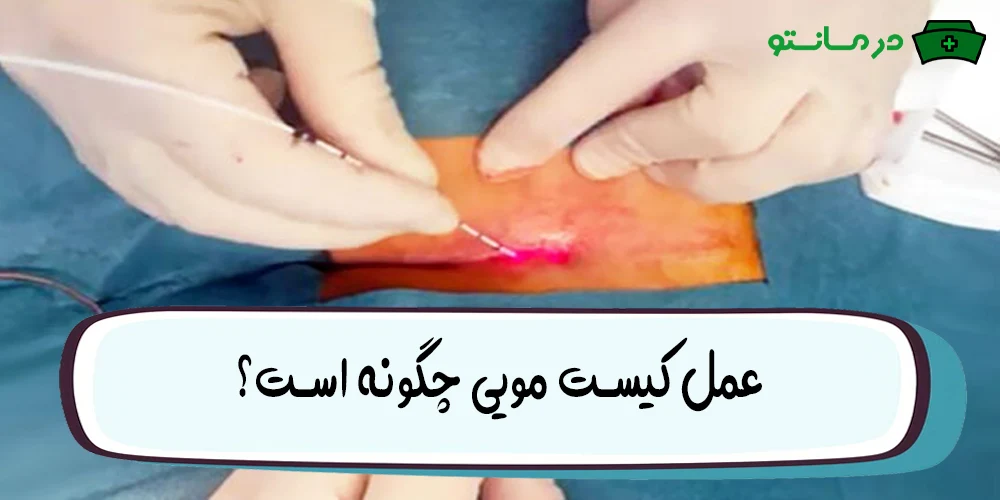 عمل کیست مویی چگونه است؟