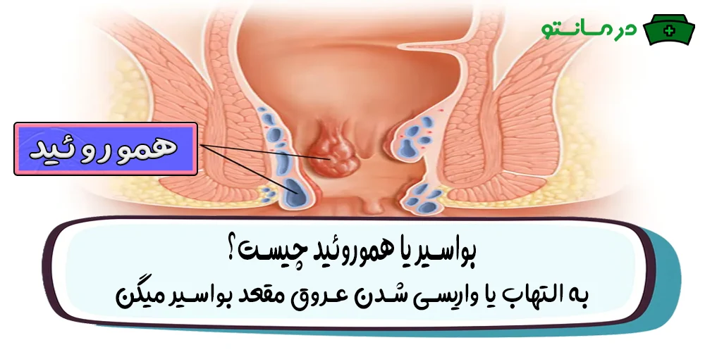 بواسیر یا هموروئید چیست؟