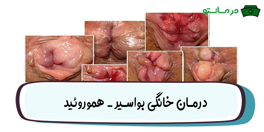 درمان خانگی بواسیر (هموروئید)
