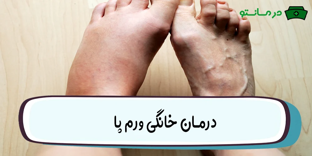 درمان خانگی ورم پا
