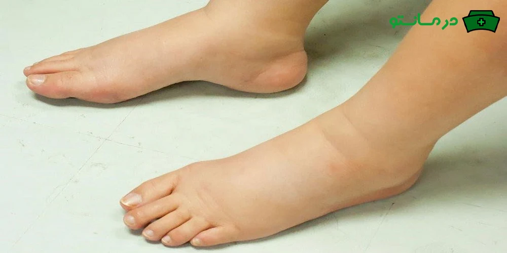 درمان ورم پا در منزل