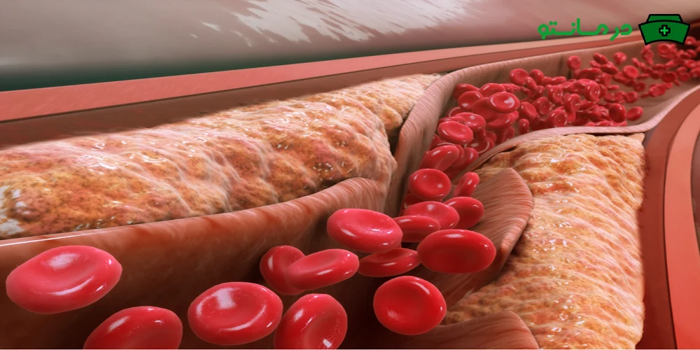 درمان چربی خون بالا در خانه