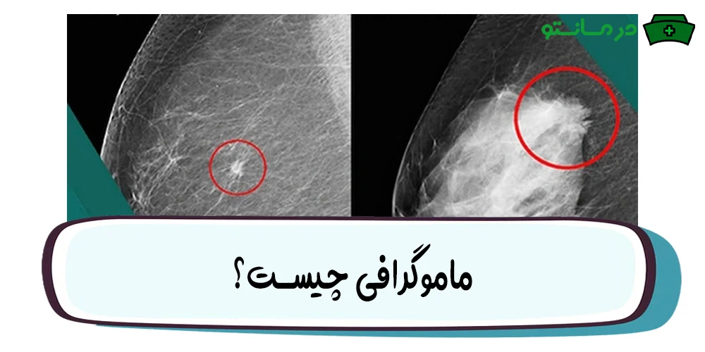 عکس ماموگرافی غیرنرمال