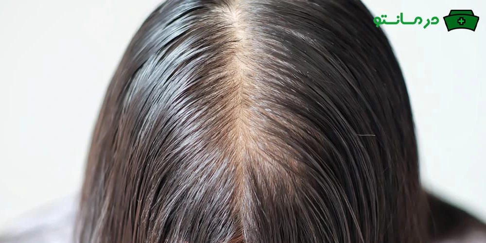 درمان چربی موی سر