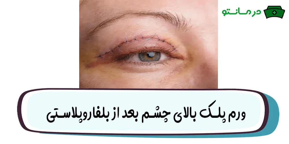 ورم پلک بالای چشم بعد از بلفاروپلاستی