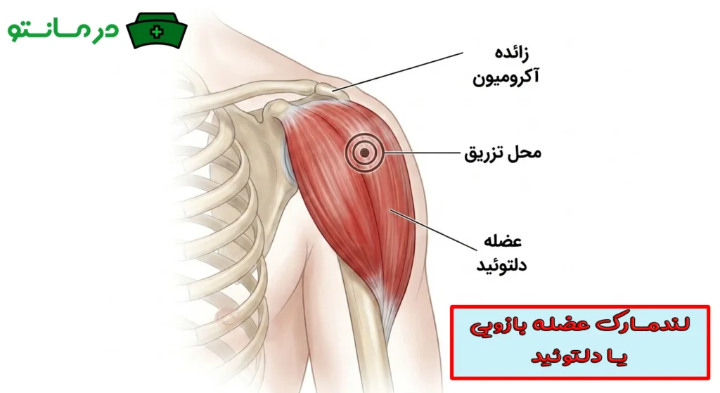 تزریق عضلانی بازویی یا دلتوئید