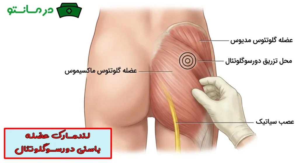تزریق عضلانی دوروگلوتئال