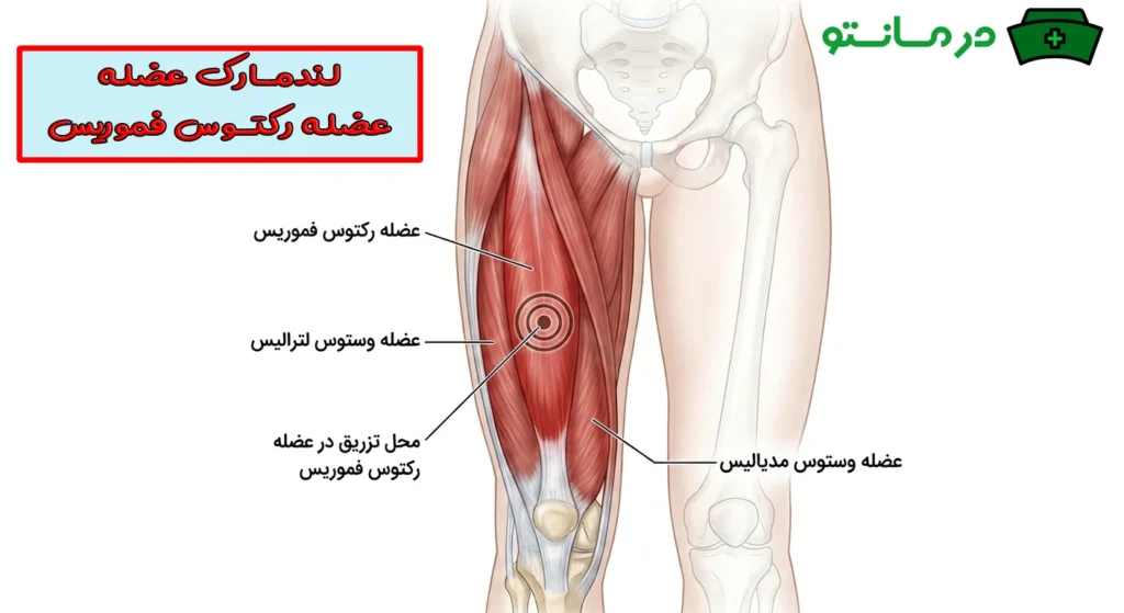 تزریق عضلانی رکتوس فموریس