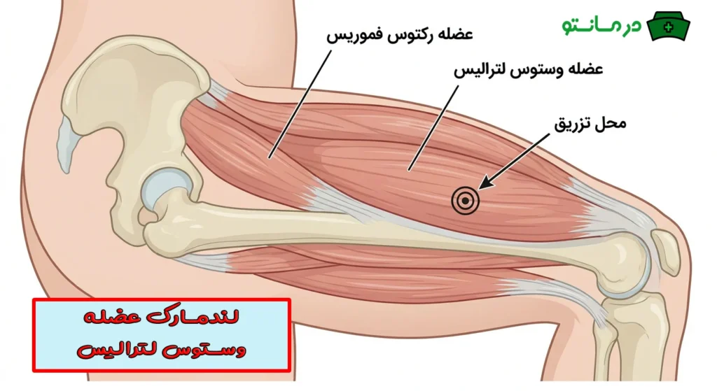 تزریق عضلانی وستوس لترالیس