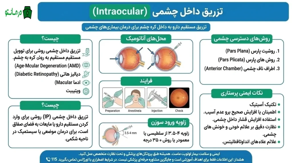 تزریق داخل چشمی (Intraocular)